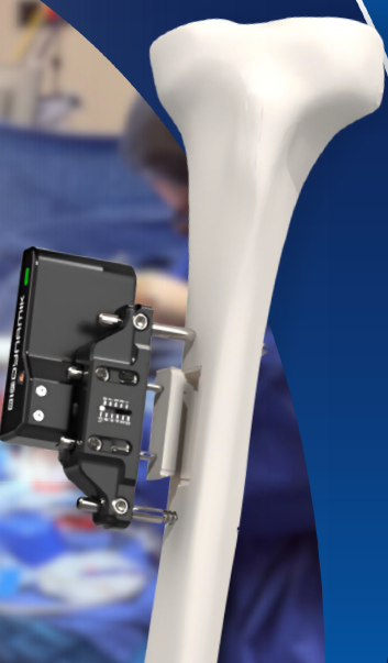 XT3 System mounted on tibia